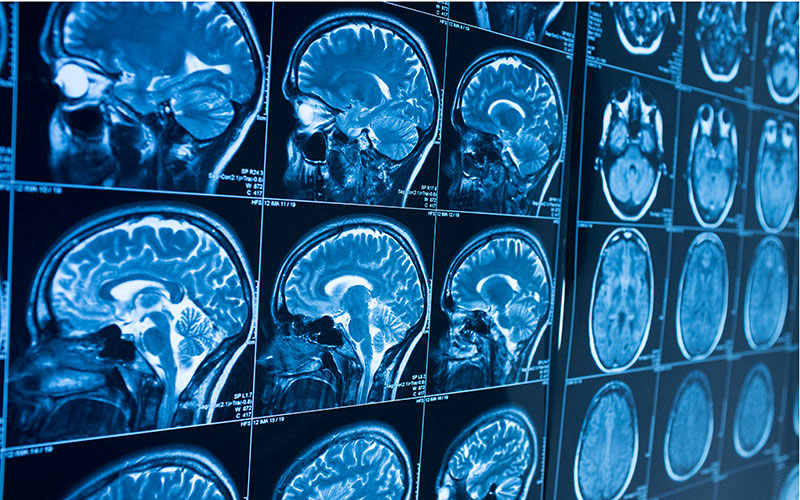brain xray, missing out on neurodiverse talent